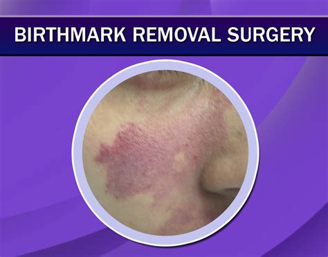 Birthmark Removal Treatment In Delhi India Pulsed Dye Laser