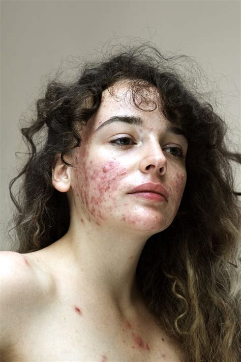 Photo Series Shows Womens Real Skin From Acne To Rosacea