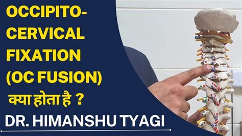 Occipito Cervical Fixation Oc Fusion क्या होता है Youtube