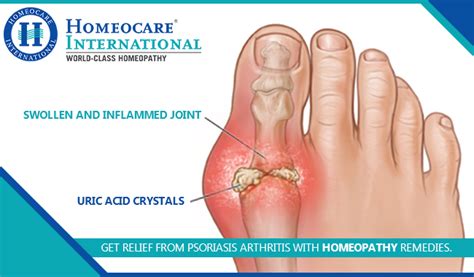 For Best Psoriasis Arthritis Treatment Approach Homeocare