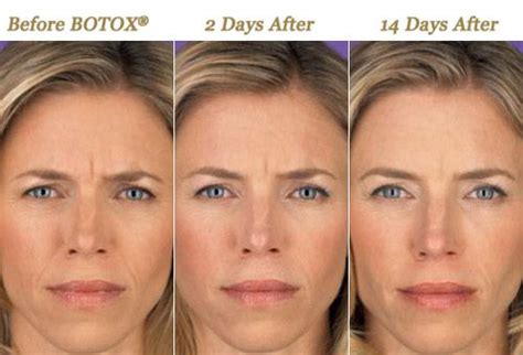 3 Phases Of Botox Before 2 Days After Injections And 14 Day After
