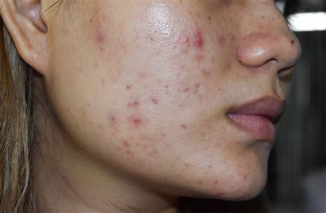 Post Inflammatory Erythema Pie Treating After Acne Red Spots Slmd