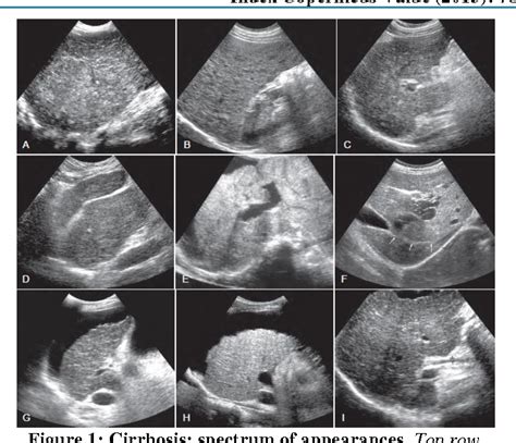 Figure 1 From Grading Of Liver Cirrhosis In Ultrasound Images Using