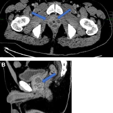 Computed Tomography Of The Pelvis With Intravenous Contrast With Axial