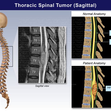 Thoracic Spinal Tumor Sagittal Trialexhibits Inc
