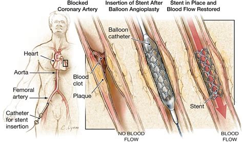 Do Angioplasties And Coronary Stenting Improve Symptoms In Patients