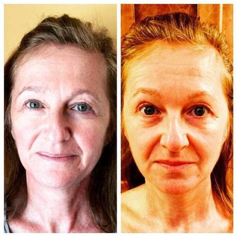 Microcurrent Treatment Before And After 8 Facelift