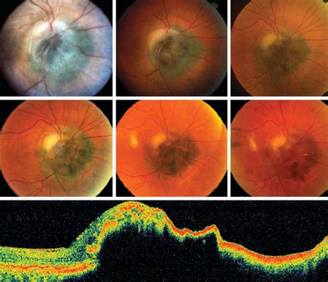 Optic Disk Melanocytoma And Optical Coherence Tomography Angiography