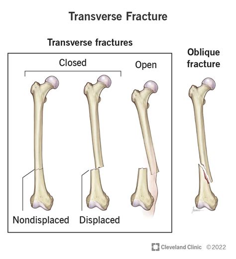 Transverse Fracture Symptoms Causes And Treatment 2023