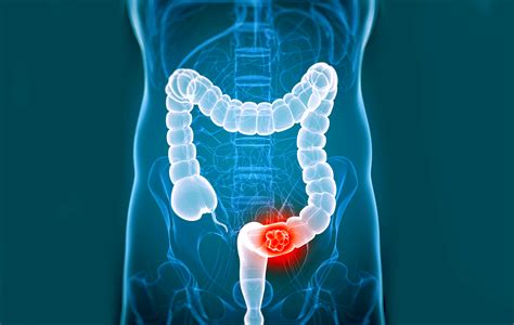 Signs And Symptoms Of Colorectal Cancer Page Of