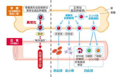 Jul 02, 2021 · 血液が作れなくなる「骨髄異形成症候群（高リスク群）」と診断され、治療薬ビダーザの投与を受けています。今年になって血液検査の数値が. 病気と症状について｜骨髄異形成症候群について｜骨髄異形成 ...