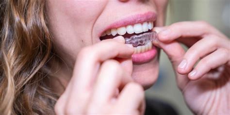 Your Complete Guide To Invisalign Treatment