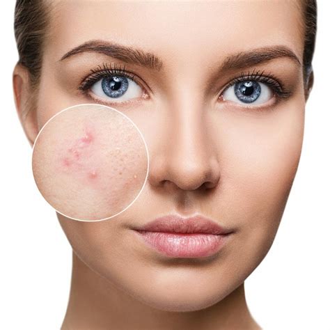 Acne Treatments Esthetics Advanced