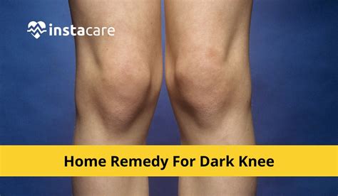 10 Home Remedies To Get Rid Of Dark Knees And Elbows