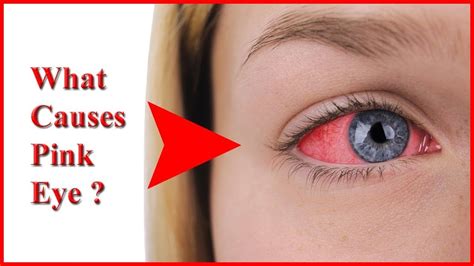 What Causes Pink Eye Top 5 Causes Of Pink Eye And Common Sources Of