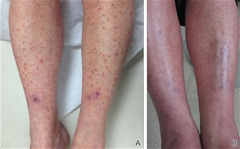 Leukocytoclastic Vasculitis Resolution With Topical Dapsone Mdedge