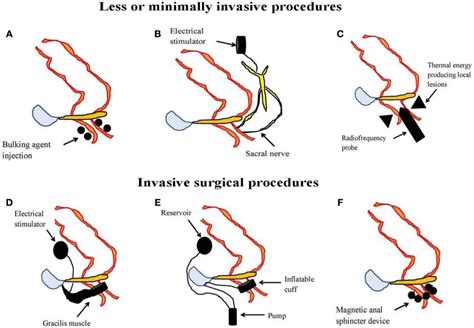 An Illustrated Summary Of Normal Defecation And Physiological