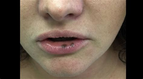 What Causes Black Patches On Lips Lipstutorial Org
