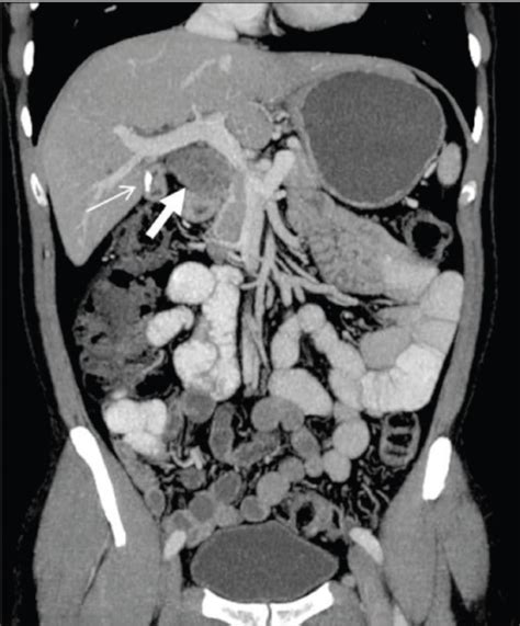 Coronal Reformatted CT Scan Reveals A Lesion Thick Whi Open I