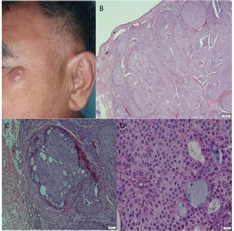 Figure 1 From Endocrine Mucin Producing Sweat Gland Carcinoma Newly