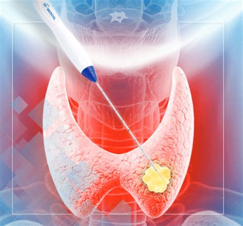 Thyroid Radiofrequency Ablation Surgical Associates