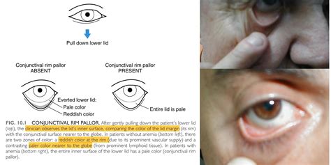 Conjunctival Pallor On Physical Exam After Gently Grepmed