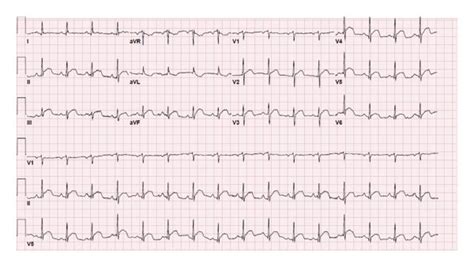 Twelve Lead Ekg Performed 24 Hours Following Admission Showing Less