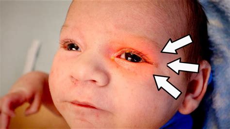 Help My Baby Has Pink Eye Dr Paul Youtube
