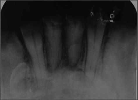 Intraoral Periapical Showing Periapical Rarefaction With All The