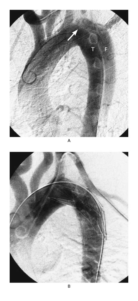 Endovascular Stentgraft Placement For The Treatment Of Acute Aortic