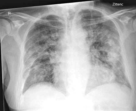 Covid 19 On Chest Radiographs A Multireader Evaluation Of An