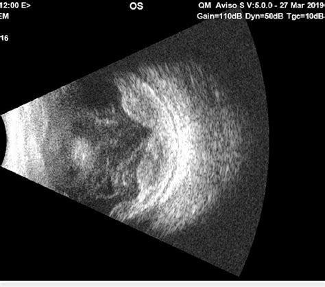 B Scan Ultrasonography Of The Eye At Presentation Showed Choroidal