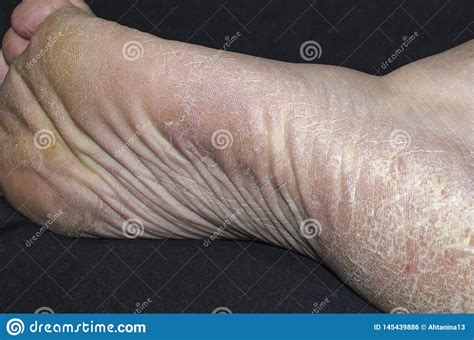Callus And Hyperkeratosis On Feet Closeup Dried Skin Stock Photo