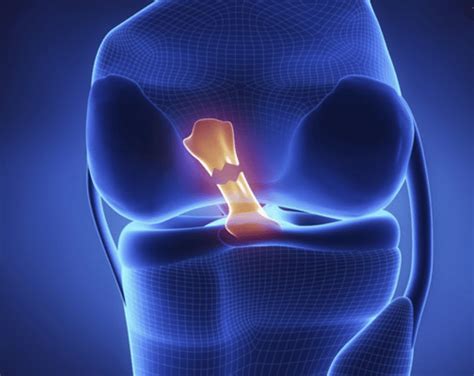 Anterior Cruciate Ligament Injuries Orthopedic Center For Sports Medicine Sports Medicine