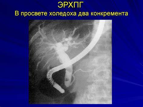 Желчнокаменная болезнь - презентация онлайн Картинка - Желчнокаменная болезнь - презентация онлайн