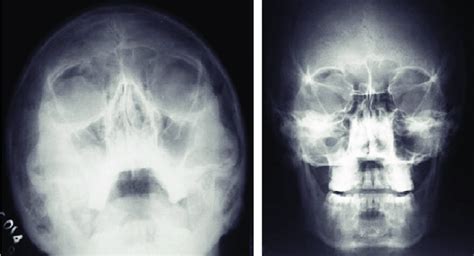 Radiographs Of The Skull Waters View And Caldwells View Showing Air