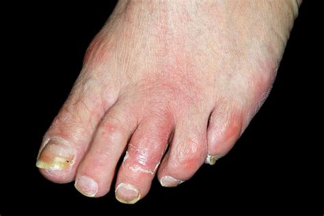 Inflamed Foot Due To Cellulitis Photograph By Dr P Marazziscience