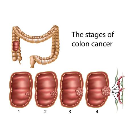 Stages Of Colon Cancer Colon Cancer Treatment In India Cytecare
