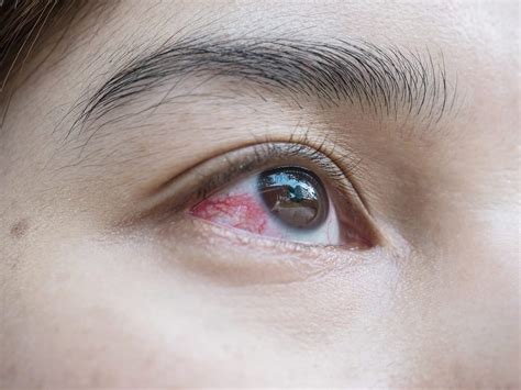 Broken Blood Vessel In Eye Phoenix Eye Doctors