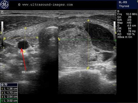 In addition, following treatment for thyroid cancer ultrasound provides a safe tool for disease surveillance. A Gallery of High-Resolution, Ultrasound, Color Doppler ...