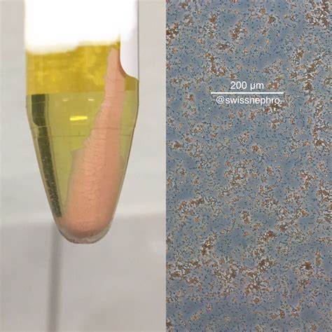 Urine Sediment Of The Month The Visible Sediment Renal Fellow Network