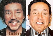 Smokey Robinson Plastic Surgery Before and After – Top Celebrity Surgery