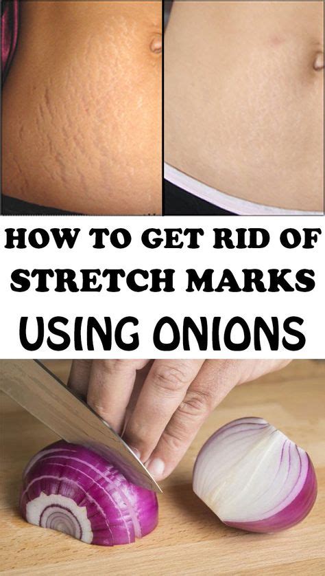 How To Get Rid Of Stretch Marks Using Onions Stretch Marks