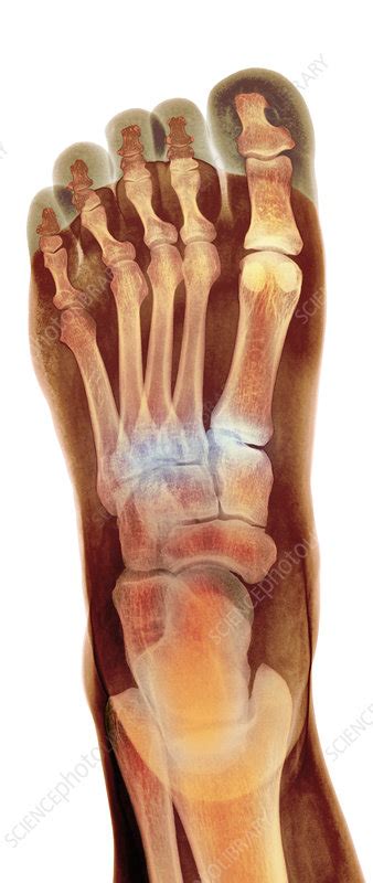 Crushed Broken Foot X Ray Stock Image M3301519 Science Photo