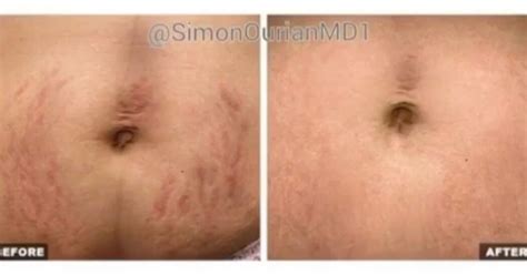 Get Rid Of Your Stretch Marks With Celebrity Doctor Dr Simon Ourian