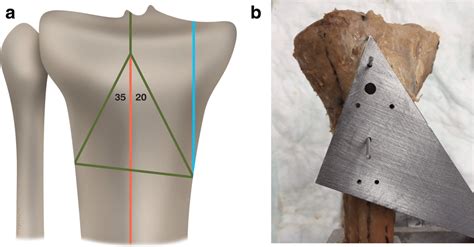 A Illustration Showing The Osteotomy Positions And Angles Used To