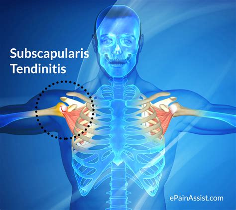 Subscapularis Tendinitis Treatment Recovery Causes Symptoms 57584 The