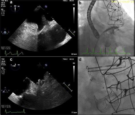 Left Atrial Appendage Atriclip With Residual Stump Present And Post