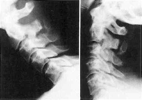 Isolated Symptomatic Cervical Spinous Process Fracture Requiring