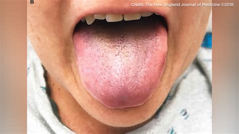 Woman Develops Black Hairy Tongue After Being Treated With Antibiotics Abc7 Chicago